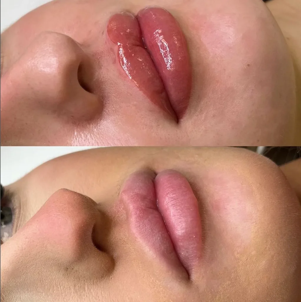 Risk Factors for Cold Sores After Lip Treatments