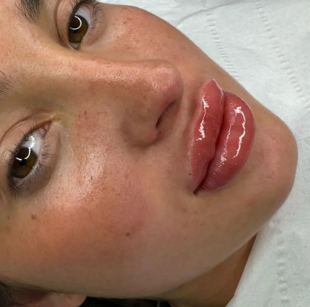 What to Do if You Get Cold Sores After Lip Tattoo